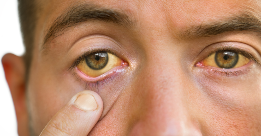 What is jaundice? HomedIQ